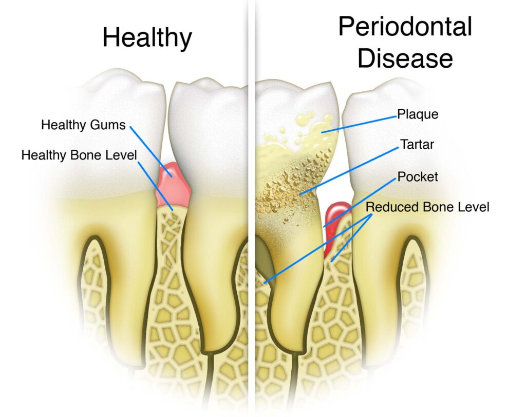 gum disease wimbledon