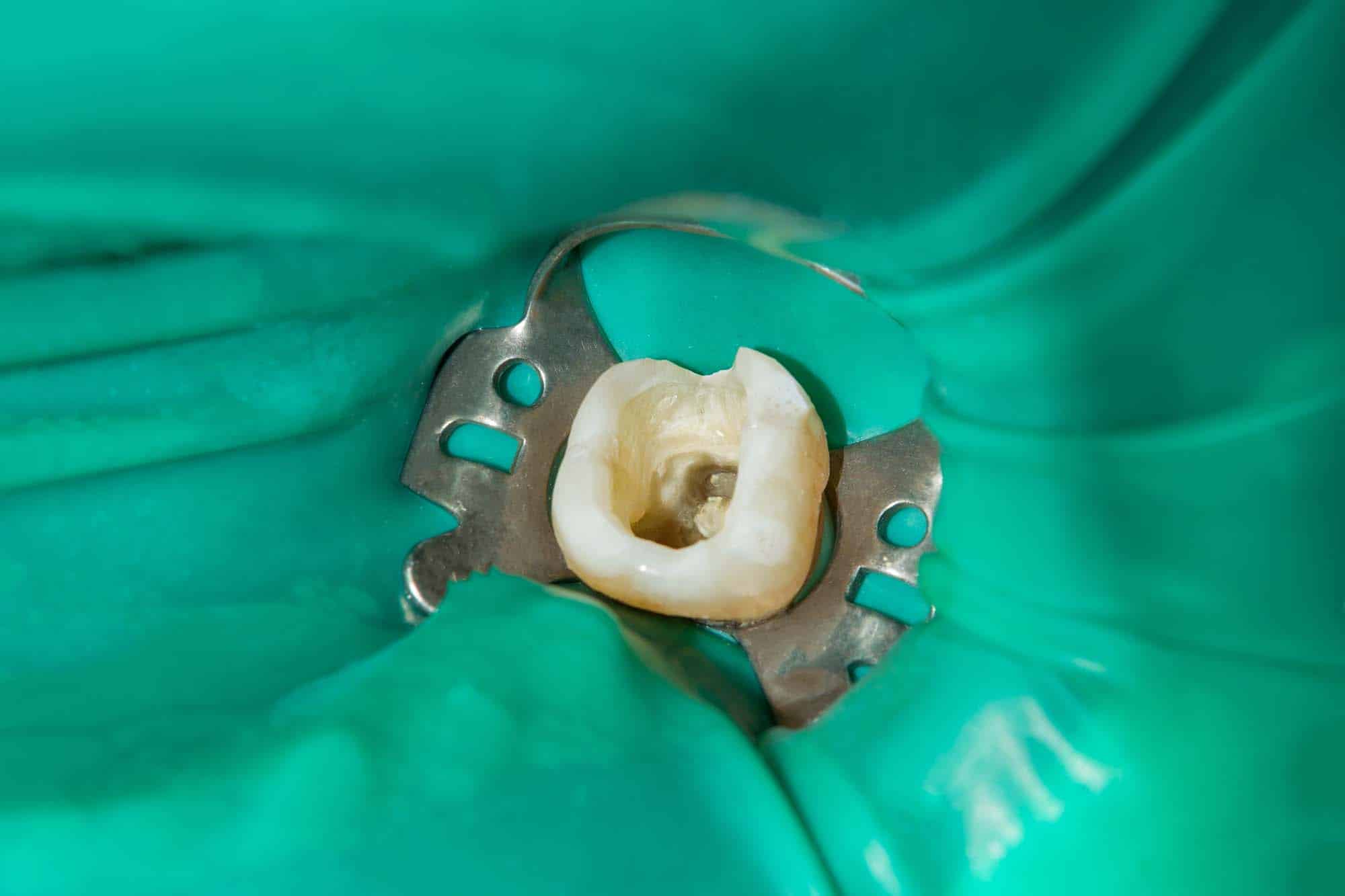 root canal treatment wimbledon