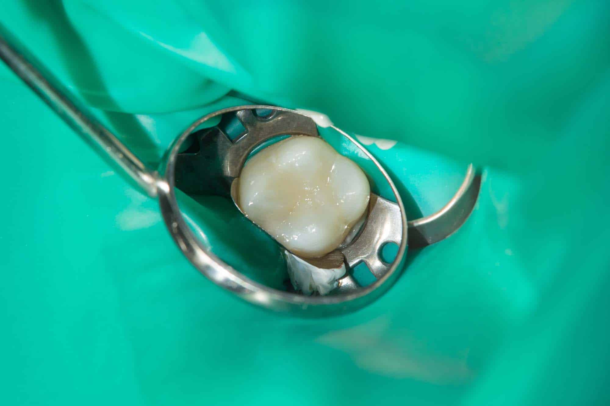 wimbledon root canal treatment