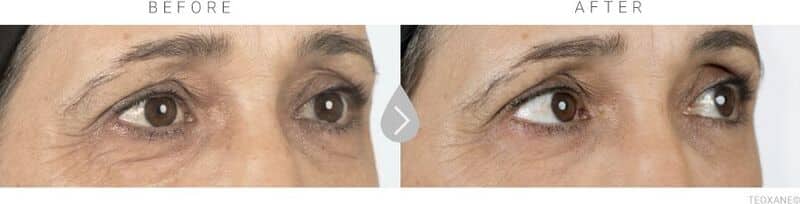 wimbledon dermal fillers